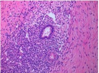 Figure 1. Pathological view of pelvic endometriosis lesions