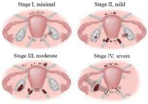 Figure 3. Criteria for revised classification of endometriosis by the American Society for Reproductive Medicine