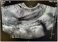 Figure 2. Longitudinal view (anteroposterior length: CD and cervical length: AB)