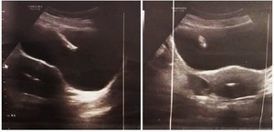 Figure 1. Ultrasound image showing IUD in uterus and bladder