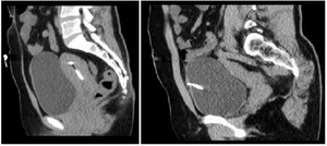 Figure 2. CT scan showing IUD in the bladder and uterus