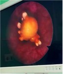 Figure 3. Cystoscopic view of the migrated intrauterine device (IUD)